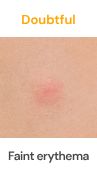 Doubtful patch test result