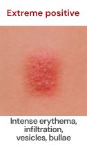 Extreme positive patch test result