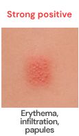 Strong positive patch test result