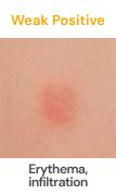Weak positive patch test result